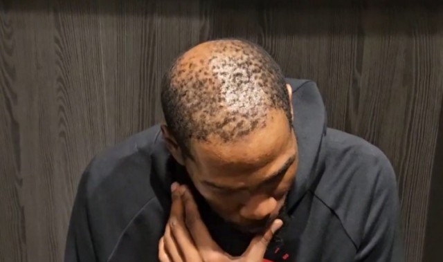 开云-37岁还单身有原因😳！杜兰特秃顶这么严重 这发量找对象难啊